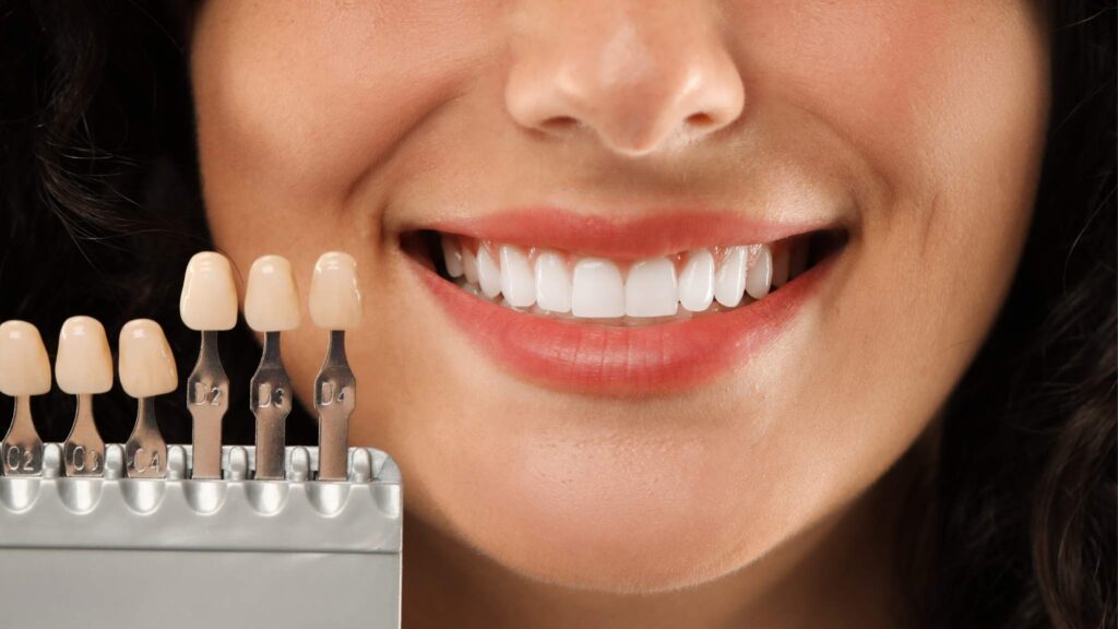 Before & After with Composite Veneers in Delray Beach, FL